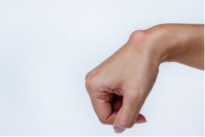 Wrist Ganglion