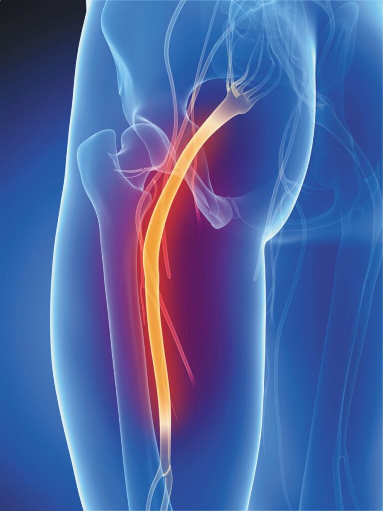 Sciatic nerve running through the buttock