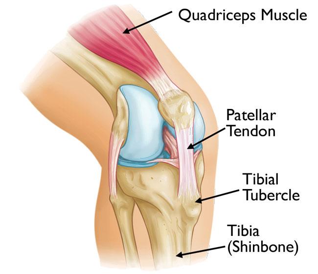 Osgood Tibia Tuberosity