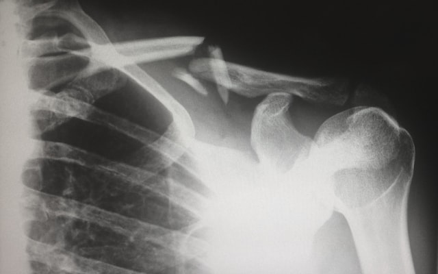 Fractured collar bone